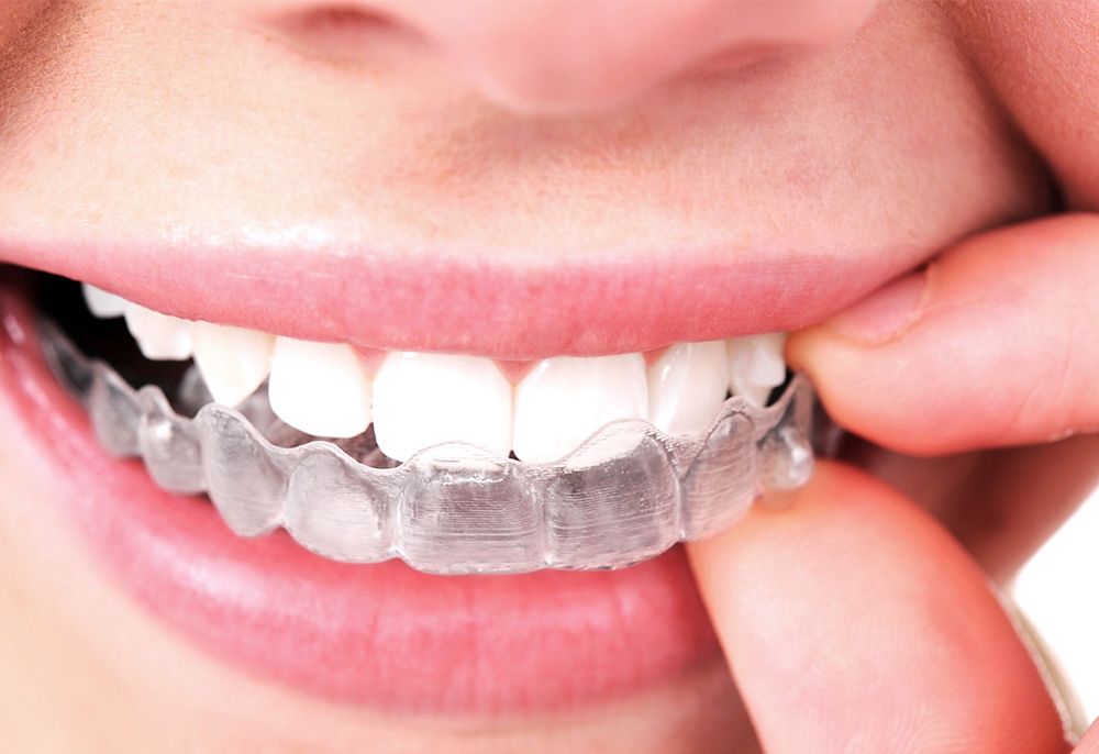 Invisalign