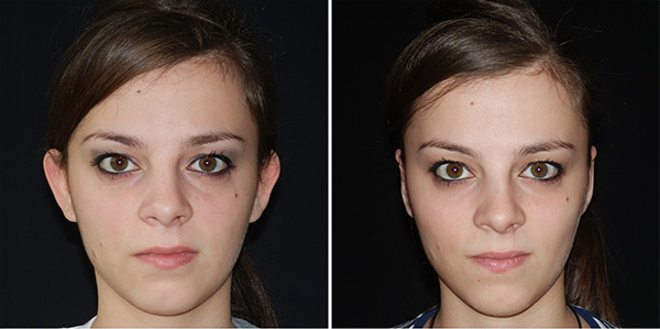 Blefaroplastika