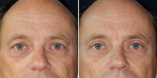 Blefaroplastika