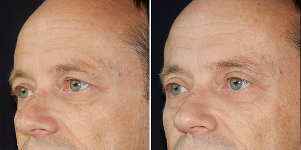 Blefaroplastika
