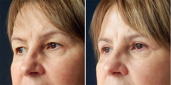 Blefaroplastika