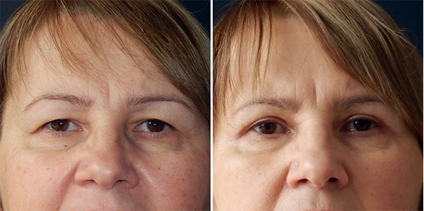 Blefaroplastika