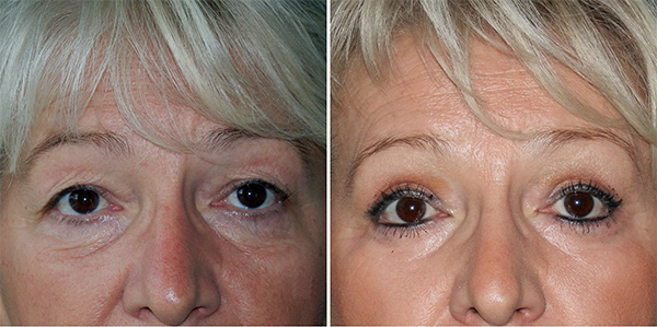 Blefaroplastika