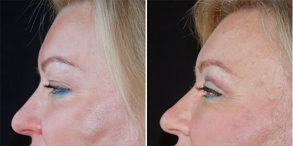 Blefaroplastika