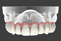 Implantologia dentale: il carico immediato è un intervento per tutti?