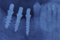 Implantologia immediata - Quante visite dovrò fare per un restauro completo della bocca?