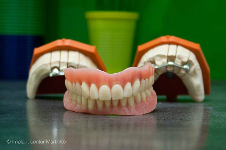 Protesi dentali semifissa su impianti per tutta l'arcata - Overdenture Protesi dentali semifissa su impianti per tutta l'arcata - Overdenture