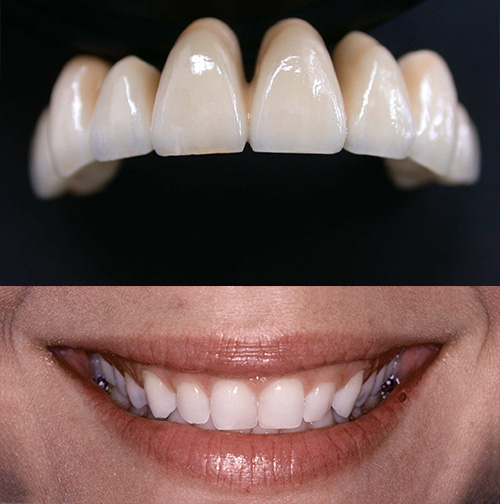 Le corone in Zirconio